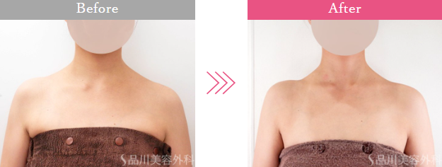 品川美容外科の肩ボトックス症例写真