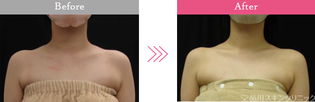 品川美容外科の肩ボトックス症例写真