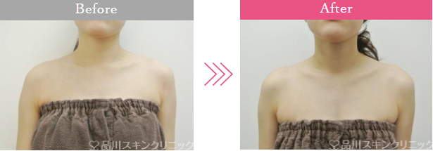 品川美容外科の肩ボトックス症例写真