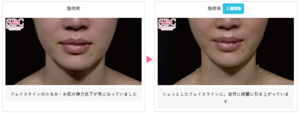 湘南美容クリニックのうるおいコラーゲンリフトの症例