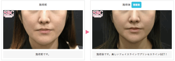 湘南美容クリニックのうるおいコラーゲンリフトの症例