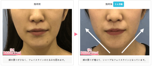 湘南美容クリニックのうるおいコラーゲンリフトの症例