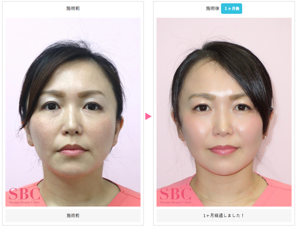 湘南美容クリニックのうるおいコラーゲンリフトの症例