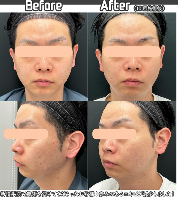 湘南美容クリニックのブラックピールの症例（ニキビ）