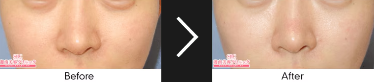 湘南美容クリニックのブラックピールの症例（くすみ）