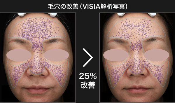 湘南美容クリニックのブラックピールの症例（毛穴）