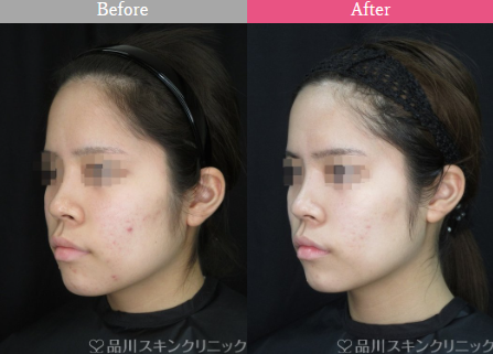 品川美容外科ケミカルピーリング+フォトシルクプラス+パール美肌の症例写真