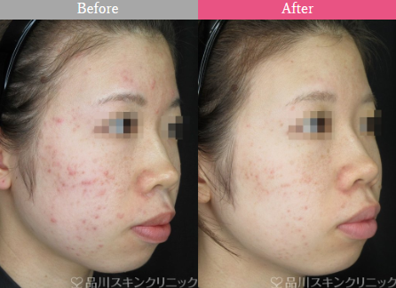 品川美容外科ケミカルピーリング+フォトシルクプラス+パール美肌の症例写真