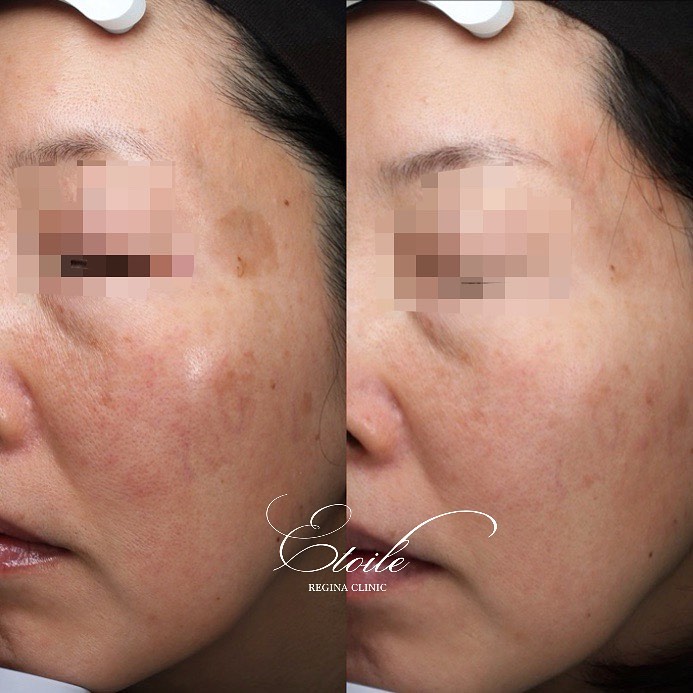 エトワールレジーナクリニックのシミ取り症例写真