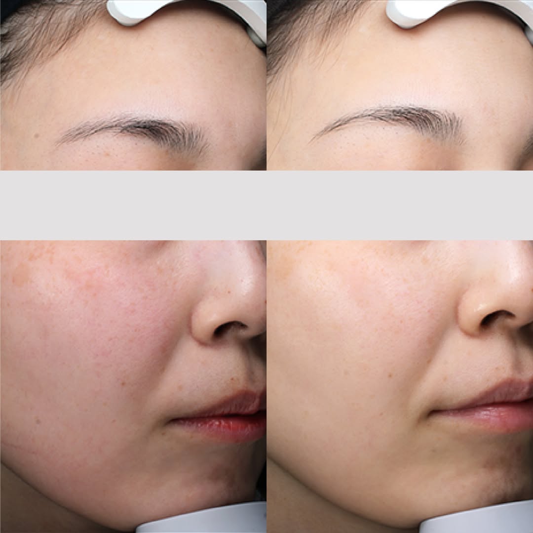 エトワールレジーナクリニックのシミ取り症例写真