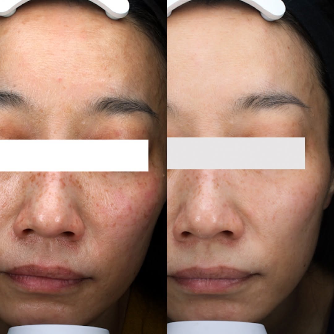 エトワールレジーナクリニックのシミ取り症例写真