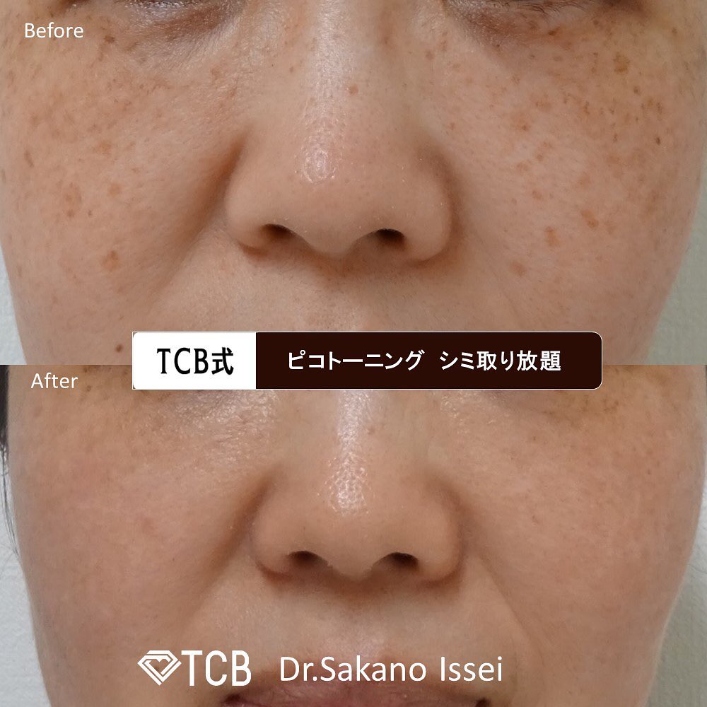 TCBのシミ取り症例写真