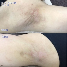 エトワールレジーナクリニックのシミ取り症例写真
