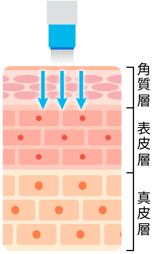 皮膚に微小な穴を生成
