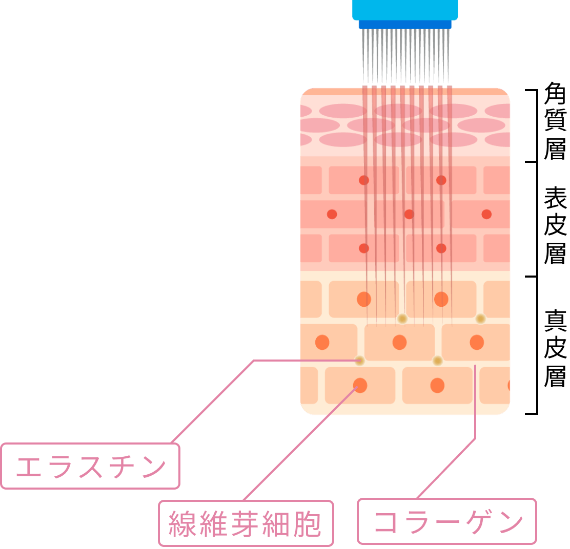 線維芽細胞が活性化