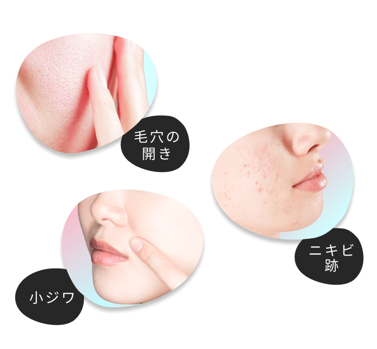 毛穴の開き、ニキビ跡、小ジワ