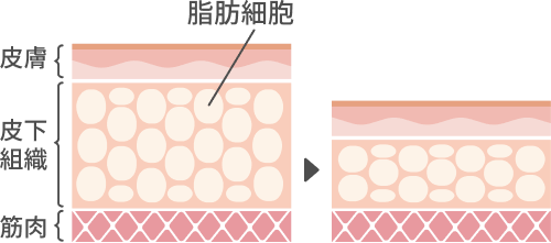 部分痩せの新しい選択肢