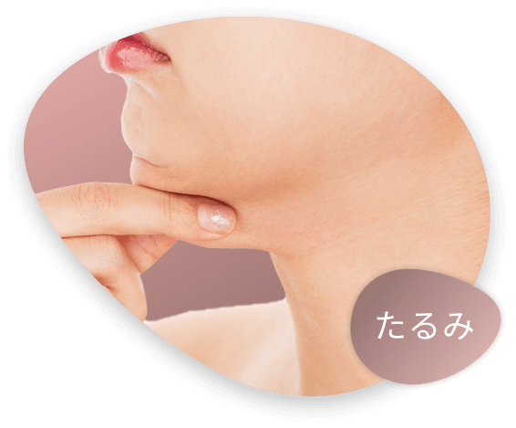 たるみ